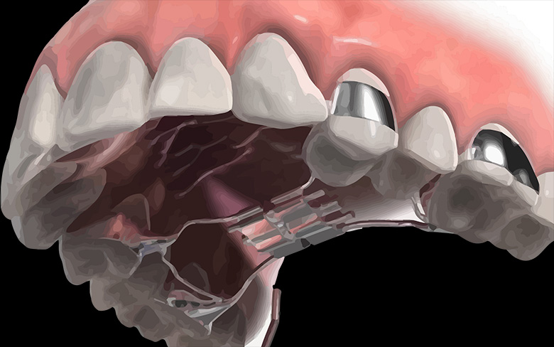 What Does a Palatal Expander Do?