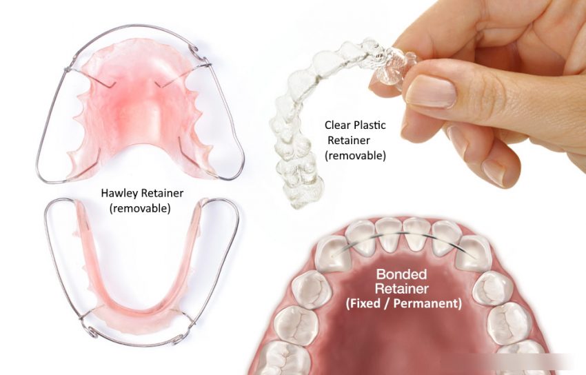 Will A Retainer Move Teeth Back Why You Should Wear Your Retainer After Braces – Stephenson