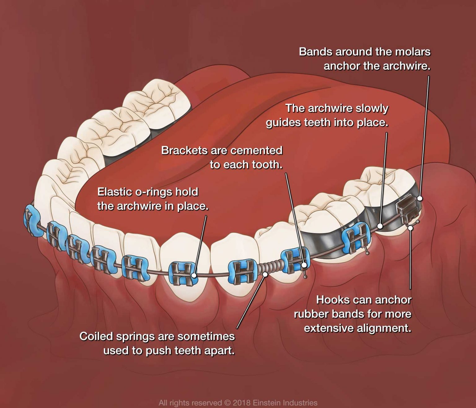 How Do Braces Work Stephenson Orthodontics Blog