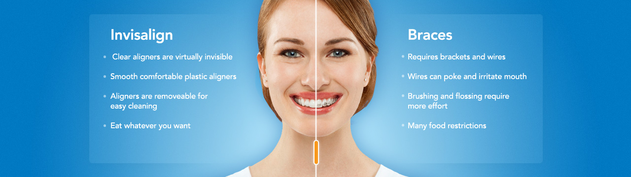 saskatoon-invisalign-vs-braces